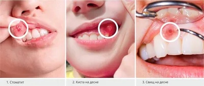 Ретинированный зуб - причины, симптомы, лечение ретинированного зуба