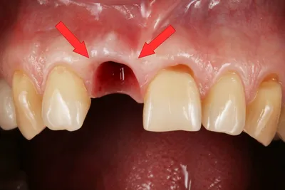 Белый налет на десне после удаления зуба, что нужно делать