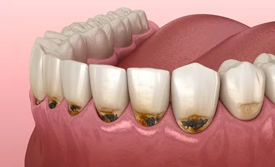 Что такое оскомина на зубах: причины и как избавиться? - Dentist-Club