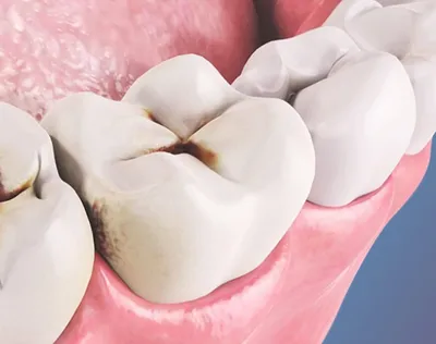 Лечение передних зубов: цена лечения кариеса от 2000 руб без боли в клинике  Доктор БОН