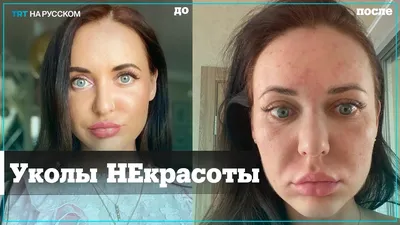 Заполнение морщин филлерами в Ужгороде | Цена процедуры в Клинике Биляка