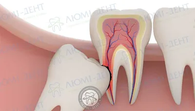 Удаление Зуба Мудрости 9 Последствий Фото Лица ЛюмиДент