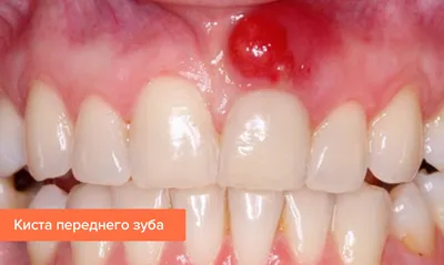 Киста после удаления зуба — симптомы и лечение