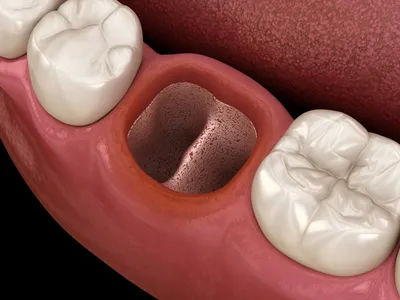 После удаления зуба опухла щека: причины отека десны и осложнения