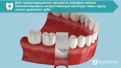 Осложнение после удаления зубов и развитие атрофии кости. Видео