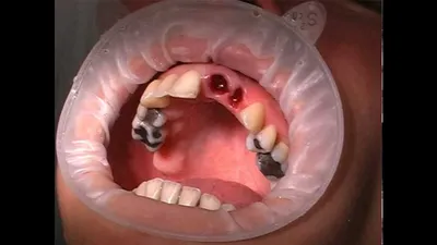 [38+] Осложнения после удаления зуба фото
