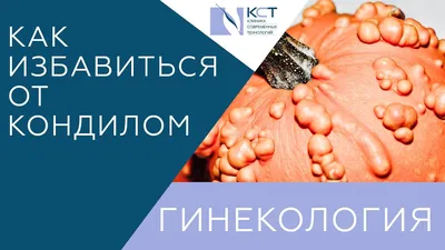 Как диагностировать остроконечные кондиломы - советы гинеколога
