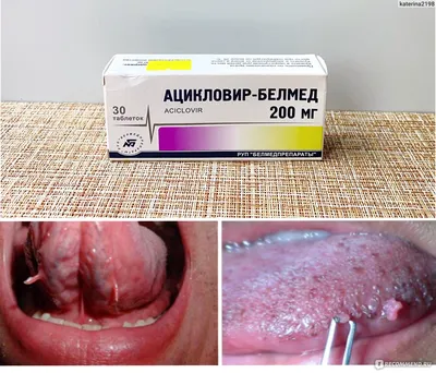 Таблетки РУП \"БЕЛМЕДПРЕПАРАТЫ\" Ацикловир 200 мг - «Ацикловир при ВПЧ.  Избавление от остроконечных кондилом во рту с помощью Ацикловира.» | отзывы