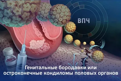 Генитальные бородавки или остроконечные кондиломы половых органов —  Семейная Клиника