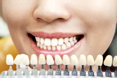 На сколько тонов можно отбелить зубы? Ответ стоматолога