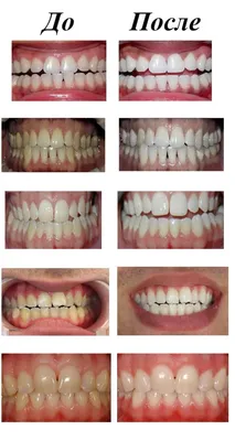Как делают отбеливание зубов, все подробности процедуры | Пикабу