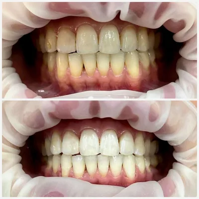 До и после. Отбеливание зубов. | Советы стоматолога | Дзен