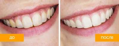 Можно ли с помощью профессиональной гигиены полости рта добиться осветления  зубов на 2-3 тона?