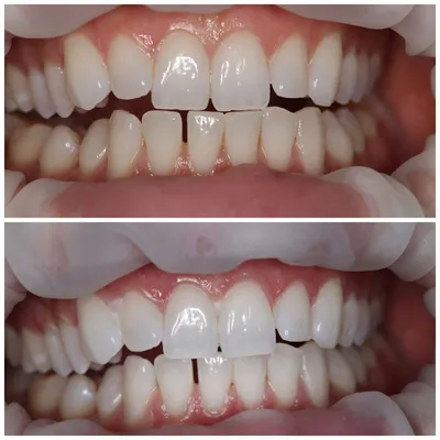 На сколько тонов можно отбелить зубы? — стоматологическая клиника Эталон  Ростов