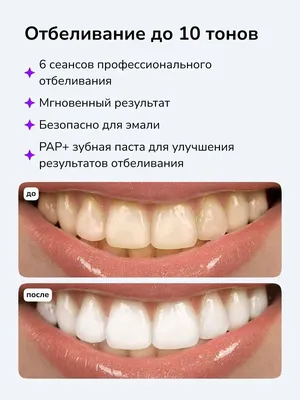 Отбеливание зубов в Тольятти по выгодной цене | Детская и взрослая  центральная стоматология