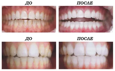 Отбеливание зубов 🦷 в МедСистема. Цена, стоимость