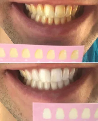 Отбеливание зубов в Danyliv Dental Practice ☎ (073) 900-31-30
