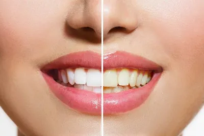 Домашнее отбеливание зубов: как быстро и безопасно отбелить зубы