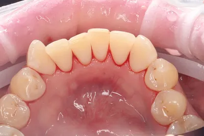 Отбеливание зубов в стоматологической клинике Ami-Clinic