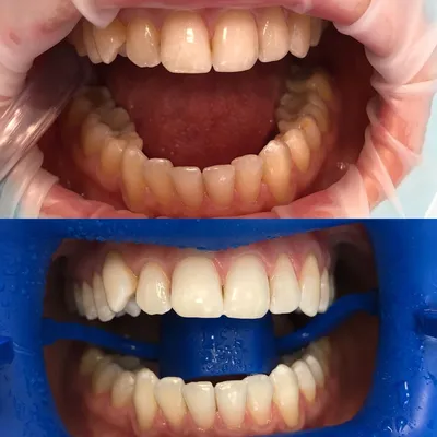 Эффективное отбеливание зубов Zoom 3. Фото, отзывы и цены | Стоматология  Дентал Мир