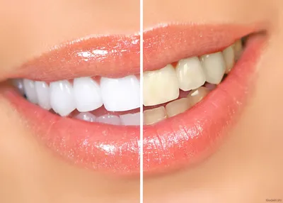 Стоматология - Что такое отбеливание зубов ✓Отбеливание зубов – это  осветление и выравнивание тона зубной эмали, удаление пигментов из верхнего  слоя дентина. Процедура относится к косметической стоматологии, но  последние технологии уже не