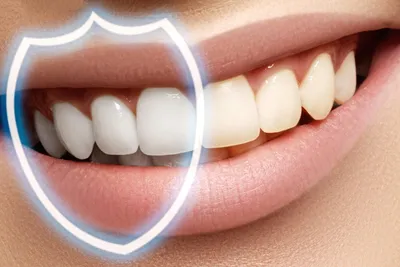Отбеливание зубов - Стоматология в Кисловодске Диамант