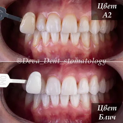 Эффективное отбеливание зубов Zoom 3. Фото, отзывы и цены | Стоматология  Дентал Мир