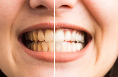 Отбеливание зубов ZOOM 4 - услуги стоматологии «Зубастик».