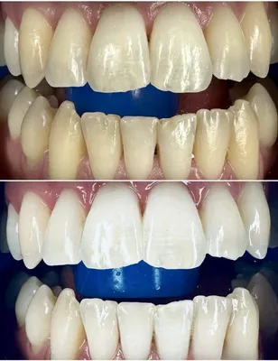 Отбеливание зубов – польза или вред? Методы отбеливания зубов