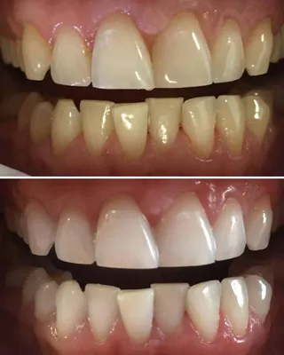 Как происходит отбеливание зубов в стоматологии