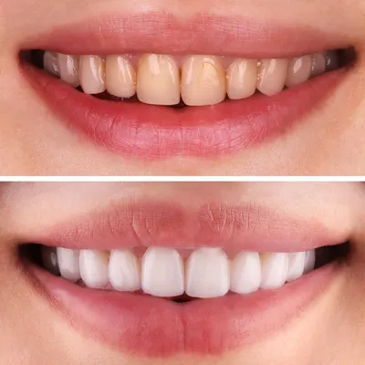 Полоски для отбеливания зубов Dighealth 7/14 пар, полоски для удаления  пятен и гигиены полости рта, инструменты для отбеливания зубов, отбеливание  зубов | AliExpress