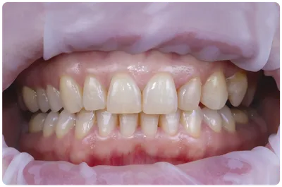 Отбеливание зубов - Lotus Dental Hévíz
