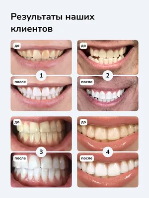 Отбеливание зубов Smileo Набор для отбеливания - «Как быстро и безопасно  отбелить зубы в домашних условиях? Набор для отбеливания Smileo, лучшее  средство, которое я пробовала!» | отзывы