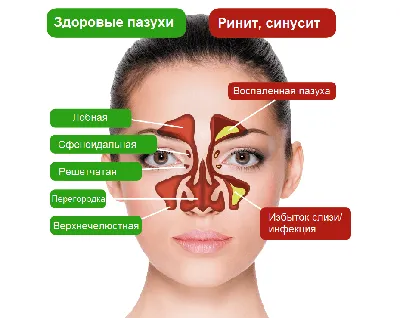 Помогает ли «Дипроспан» от отеков после ринопластики?