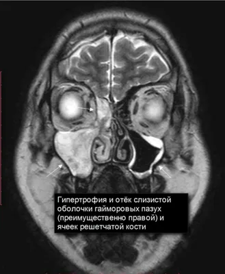 Гайморит: симптомы, причины, диагностика и лечение | Блог ЛДЦ Здоровье