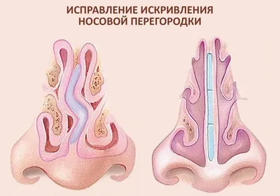 ✓Несмотря, что держится отек, мы видим, как изменился кончик носа при  Динамичной… | Пластическая хирургия, Хирургия