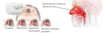 Отек Квинке у детей и взрослых - как снять аллергический отек