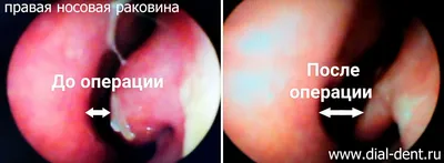 Как быстро проходят отеки после пластики носа?