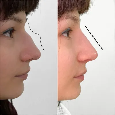 Слизистая оболочка носа: как восстановить и убрать отек?