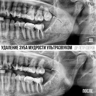 Удаление зуба мудрости ультразвуком Piezosurgery®. Без боли.