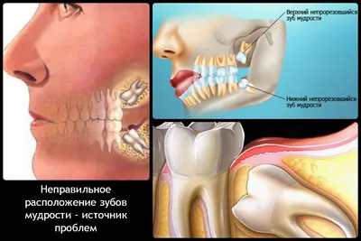 Удаление зуба мудрости, цены на удаление зубов мудрости в СПб - Анле-Дент