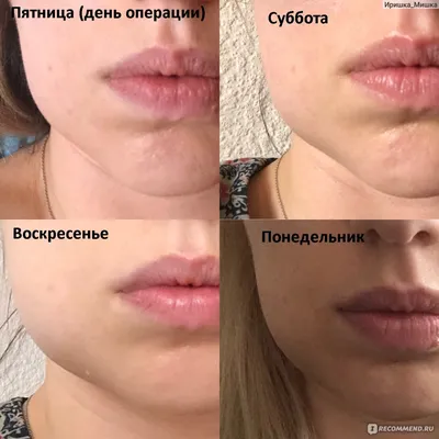 Асимметрия лица после удаления зуба мудрости