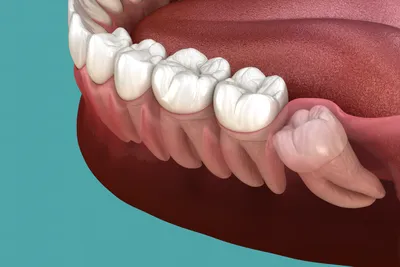 Рекомендации после удаления зуба мудрости | ООО «СВОИ ЛЮДИ»