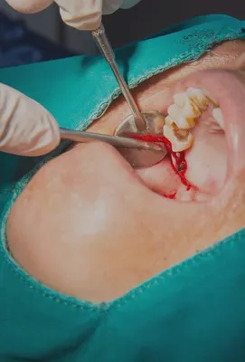 Боль после удаления зуба | Стоматология Митино