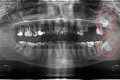 Удаление 8 зуба ультразвуком Piezosurgery®. Без боли. Центр Москвы