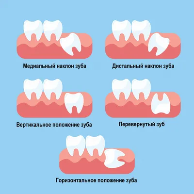 Осложнения после удаления зубов. Какие бывают и почему возникают? -  \"Фортуна\"