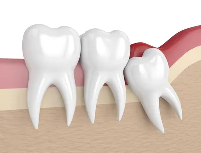 Отёк после удаления зуба это нормально, или нет | Dental Art