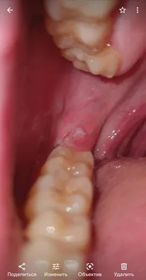 После удаления зуба мудрости опухла щека – стоматология ПрезиДЕНТ