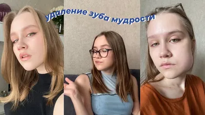 Асимметрия лица после удаления зуба мудрости