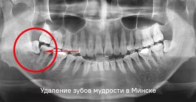 Как удаление зубов мудрости влияет на овал лица? | Tvoyzubnoy | Дзен
